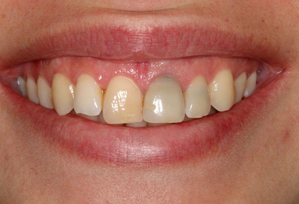 Endodoncia - Dentista Marisol Contreras