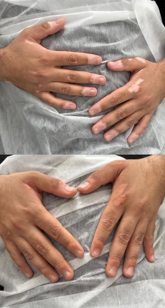 Vitiligo camouflage before and after