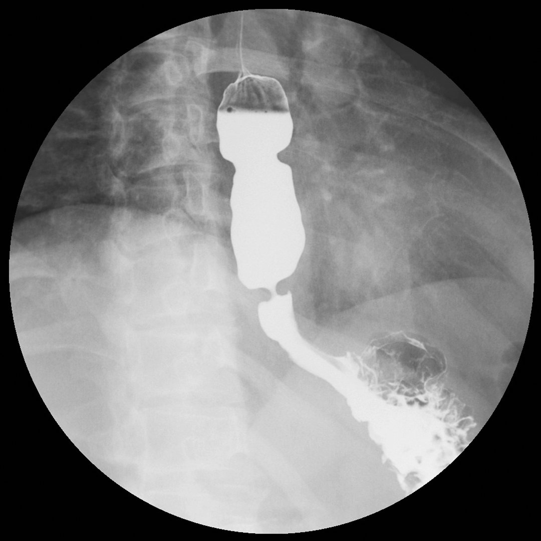 SEGD pediátrica, estudio de tránsito esofagogastroduodenal con bario