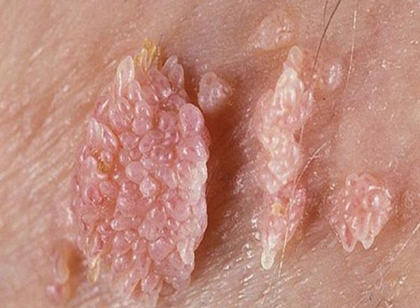 Dấu hiệu nhận biết sùi mào gà