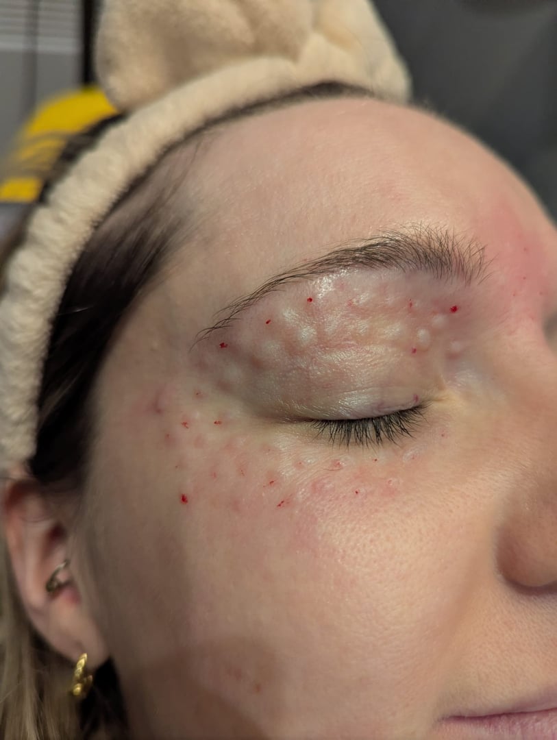 Polynucleotides eye treatment results