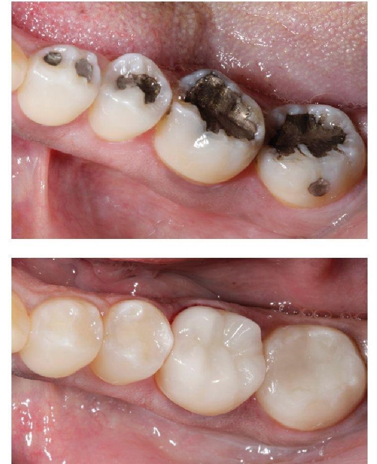 Resinas Dentales - Dentista Marisol Contreras