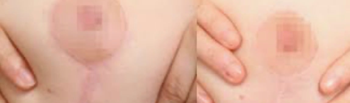 Before and after breast restoration scar camouflage result