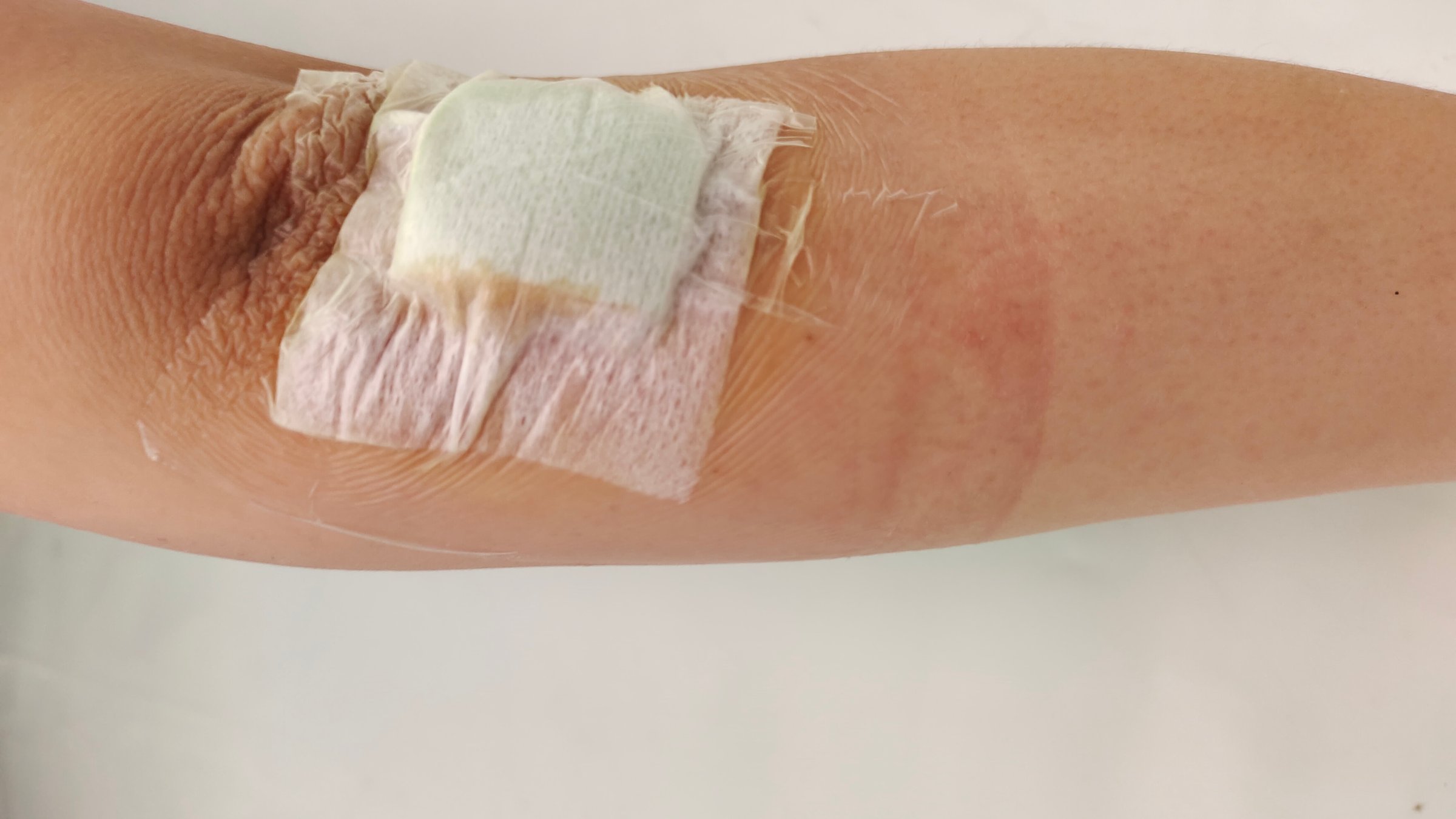 Portrait the wounds and bandages on the arm of patient woman.