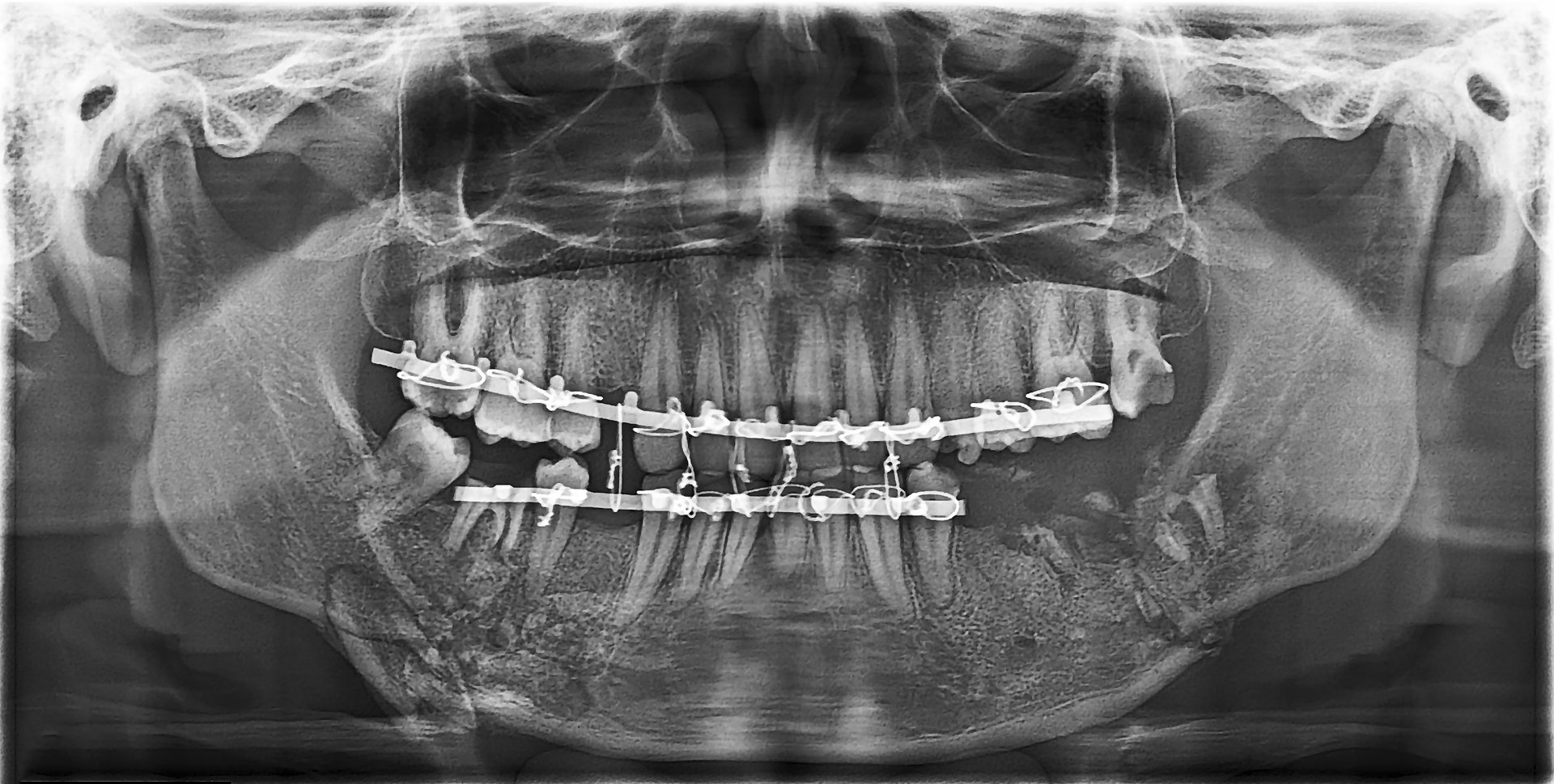 Dental panoramic x-ray showing  bone fracture and fragmentation; the maxillae and the mandible stabilized with a retention arc