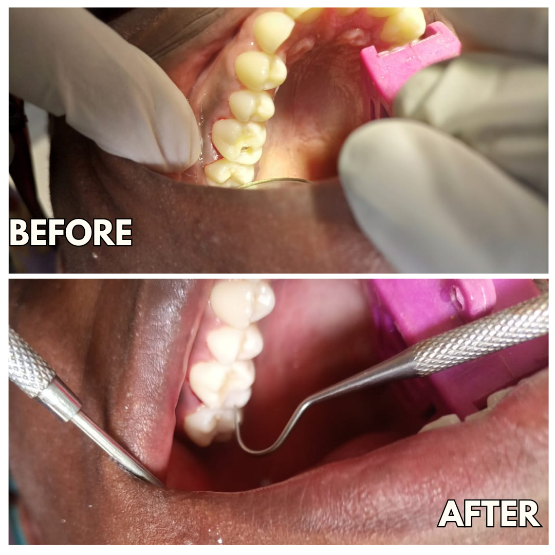 Dental filling before and after cavity treatment