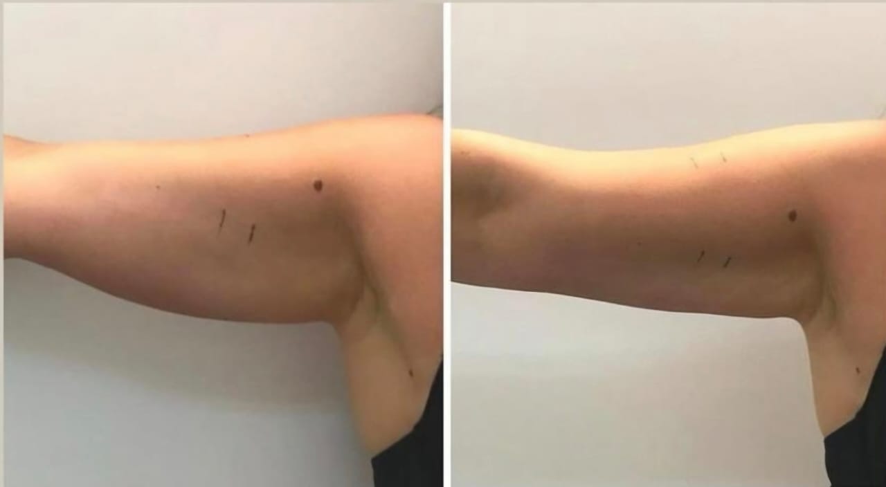 Antes y después - Lipoenzimas