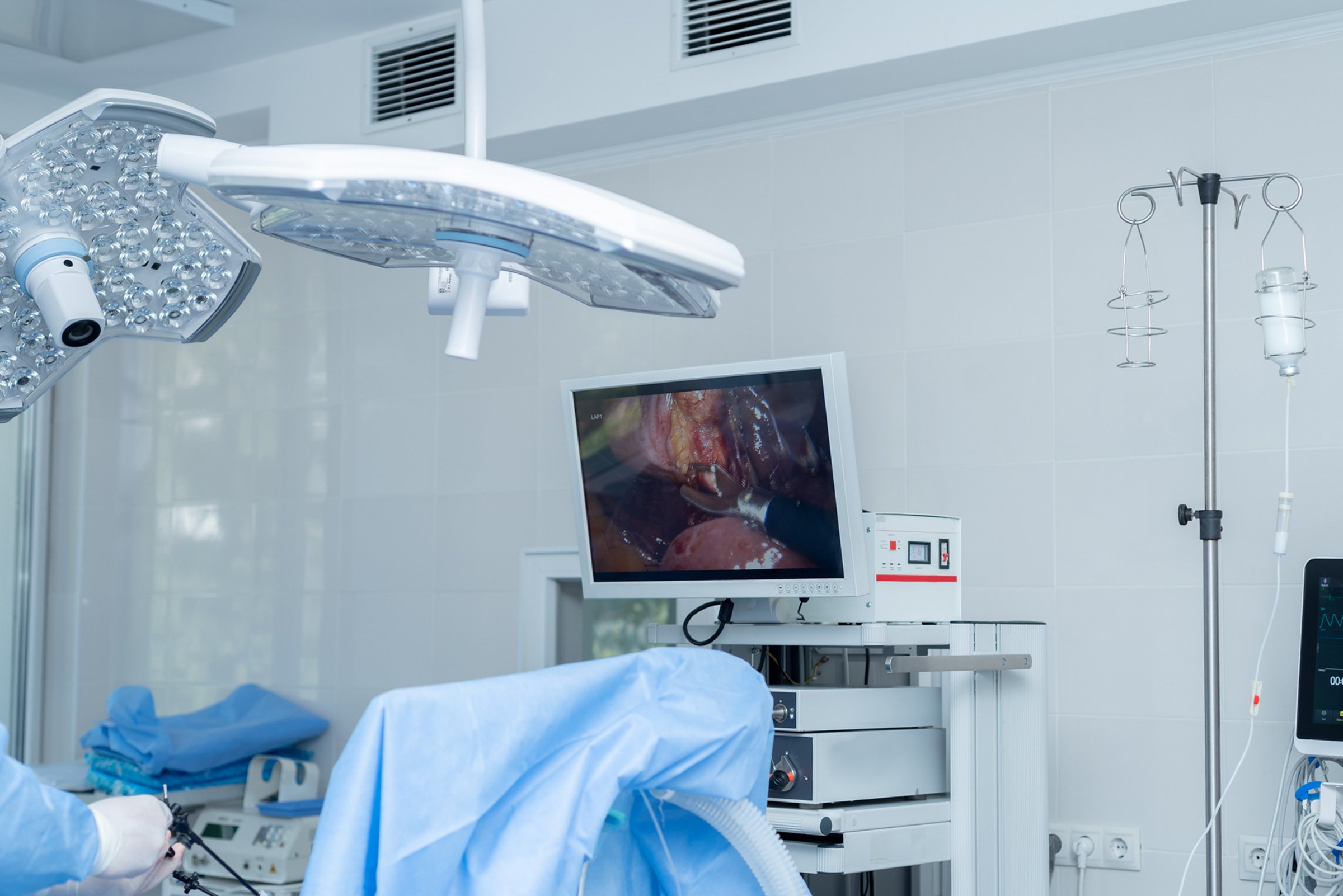 Cirugía abdominal, laparoscopia, colecistectomía, extracción de la vesícula biliar mediante endoscopio y laparoscopio, hospital, sala de operaciones, paciente bajo anestesia, médicos