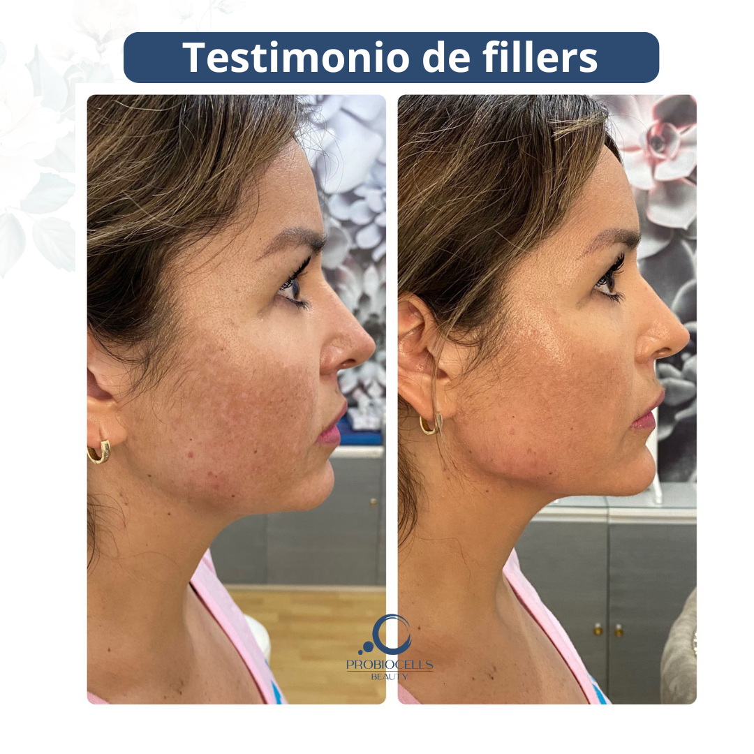 Professional fillers treatment image