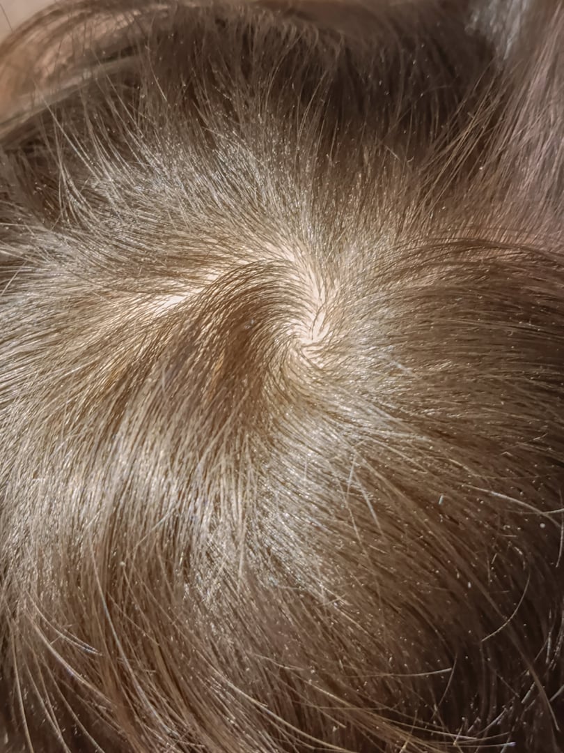 Crown of head with Mocha Mousse hair. Hairline. Top of head. Alopecia. Thinning hair on scalp.