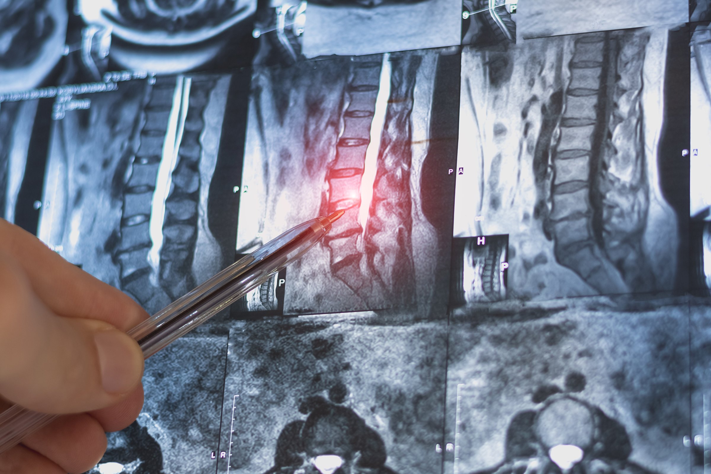 Mri scan of cervical spine hernia medical x-ray examining