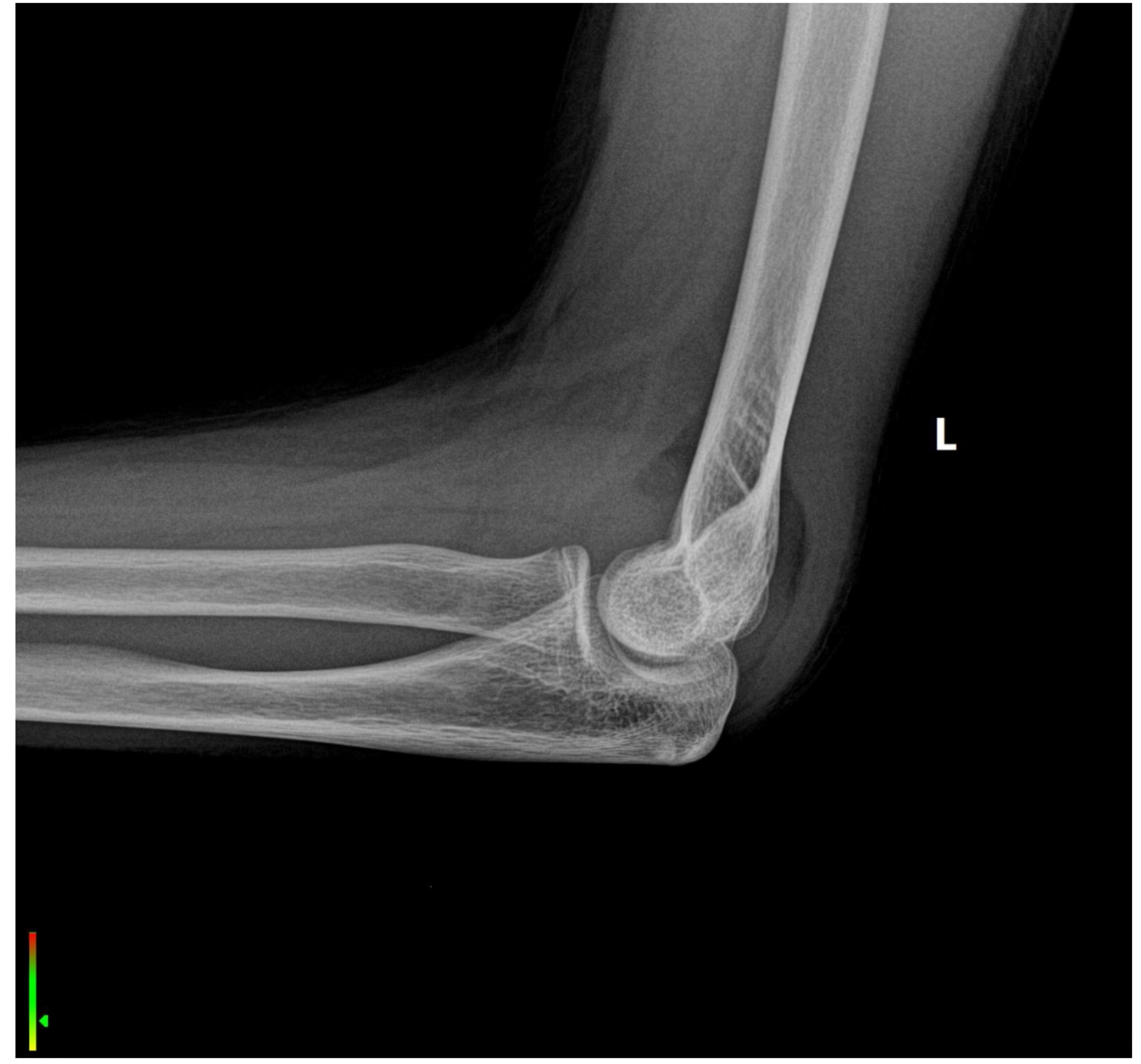 Lateral X-ray of the elbow, revealing a fracture at the elbow