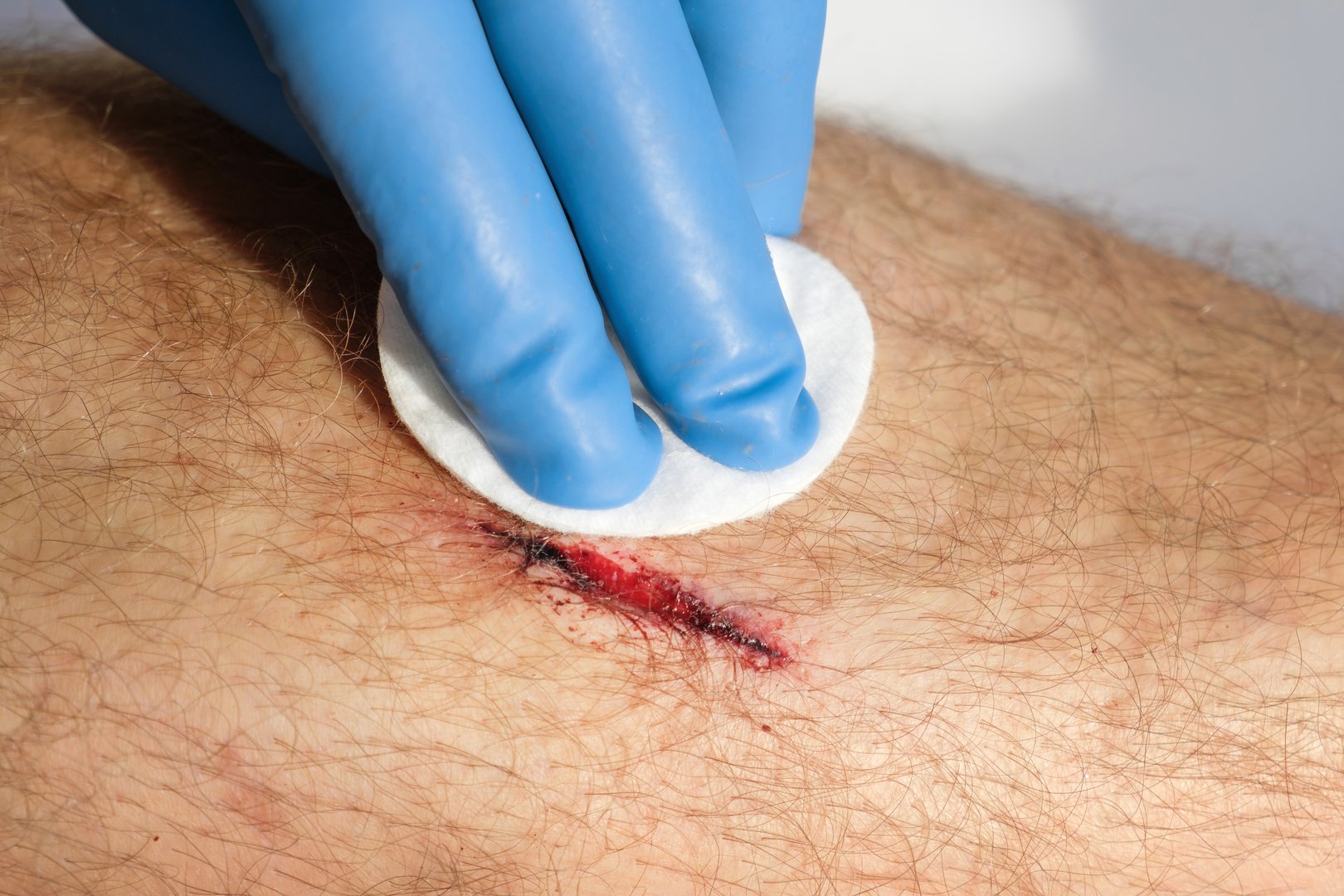 The Wound on a Leg of Young Man. Close Up. Open Red Wound, flows blood, Deep Cut, Dehiscence on Skin. Medical Concept. Laceration Closeup of a large erosion, freshly made, exposed capillaries