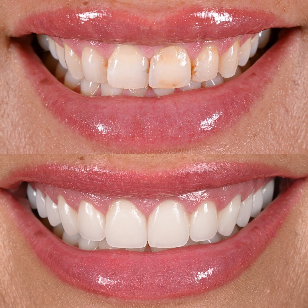 Charlotte C veneer transformation before and after