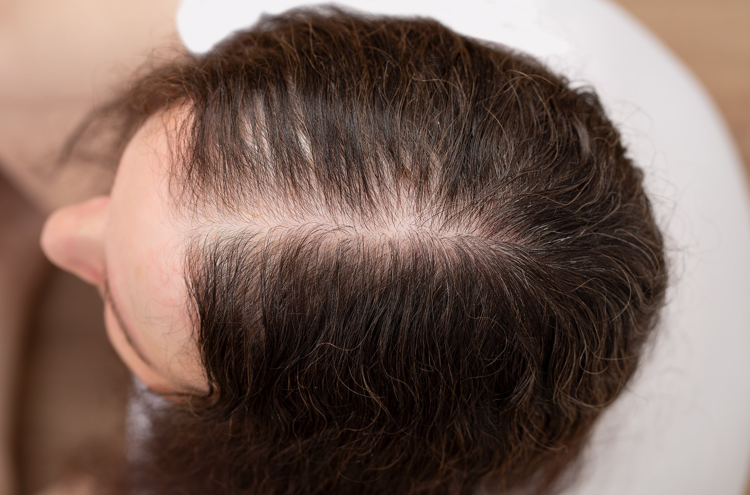 Woman with hair loss before SMP treatment in Bradenton FL - female thinning hair crown area consultation at CC Styling Studio