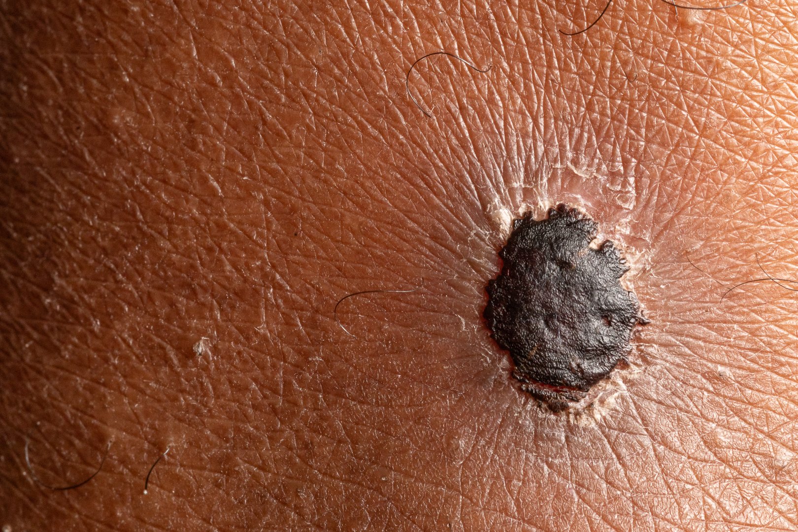 Close up of melanoma skin cancer growing on human skin