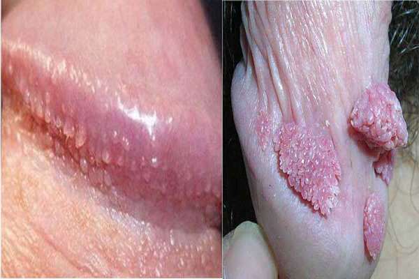 Phân biệt hạt ngọc dương vật và sùi mào gà