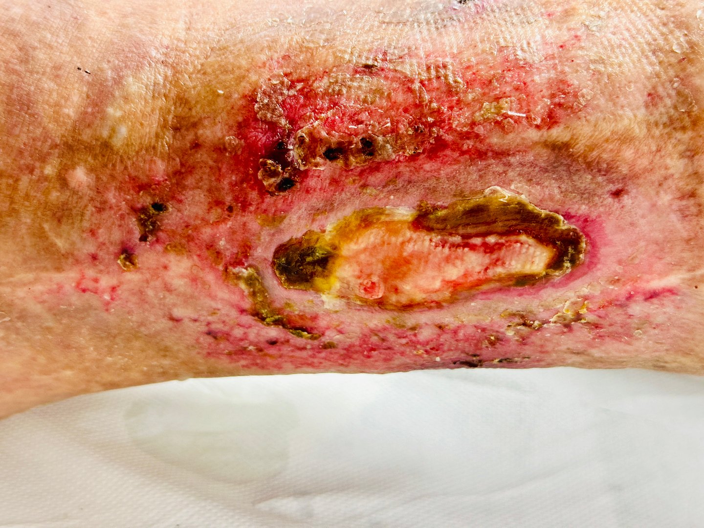 Ulcus Cruris Ulcer