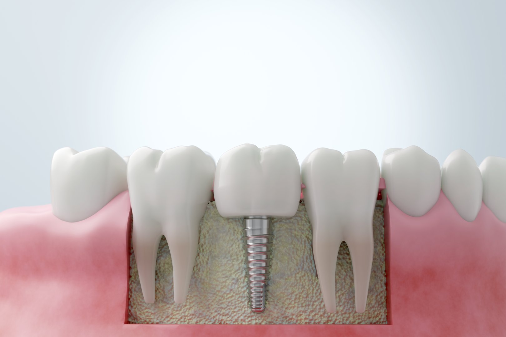 cross section titanium dental implant placed in the jawbone, illustrating the structure of the tooth root and gum. 3D medical illustration.