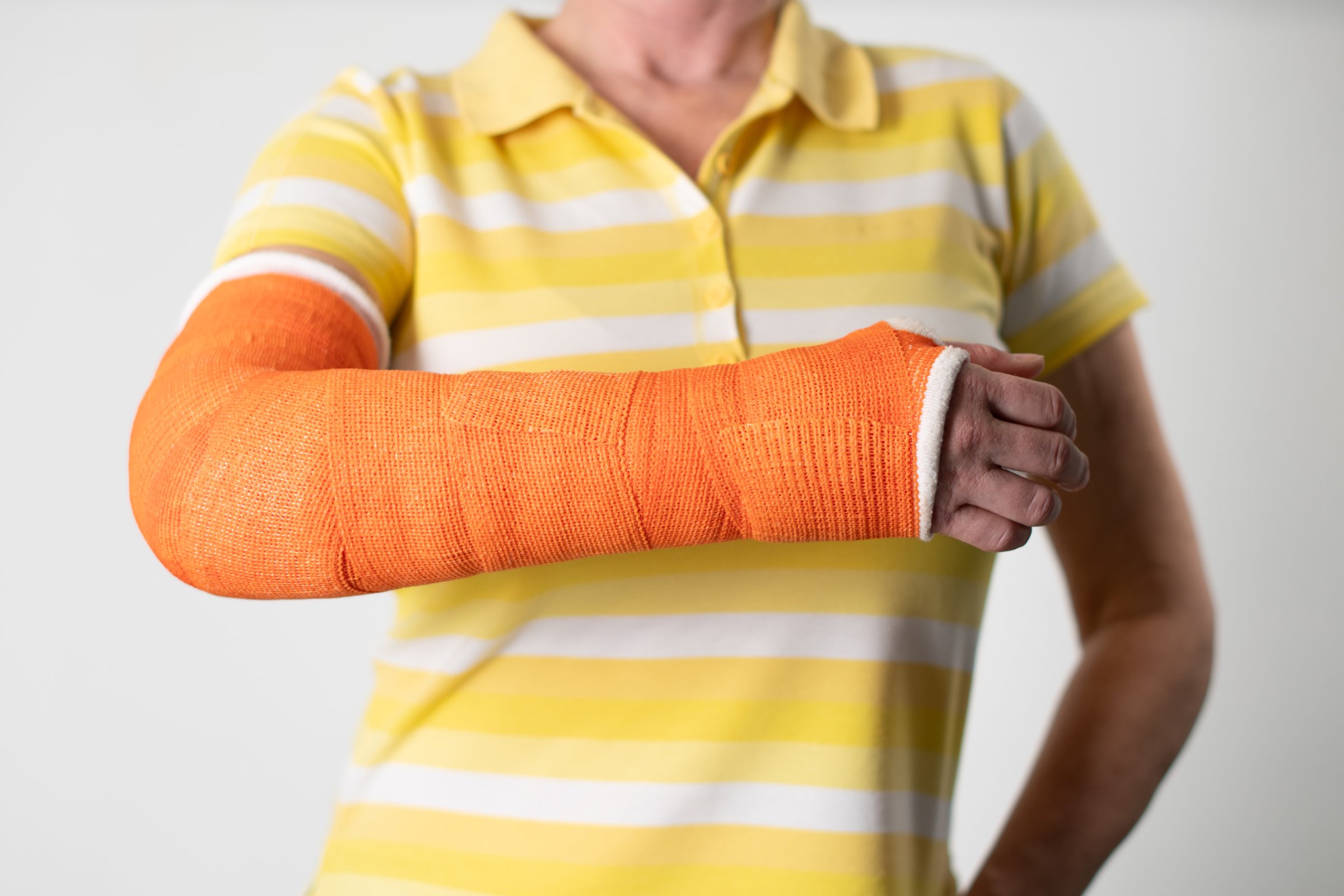 woman with a broken arm and an orange plaster plastic bandage on a white background,modern materials for the treatment of injuries,the latest medicine,copy space,High quality photo