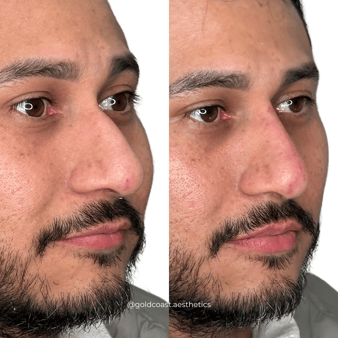 Nasal bridge enhancement