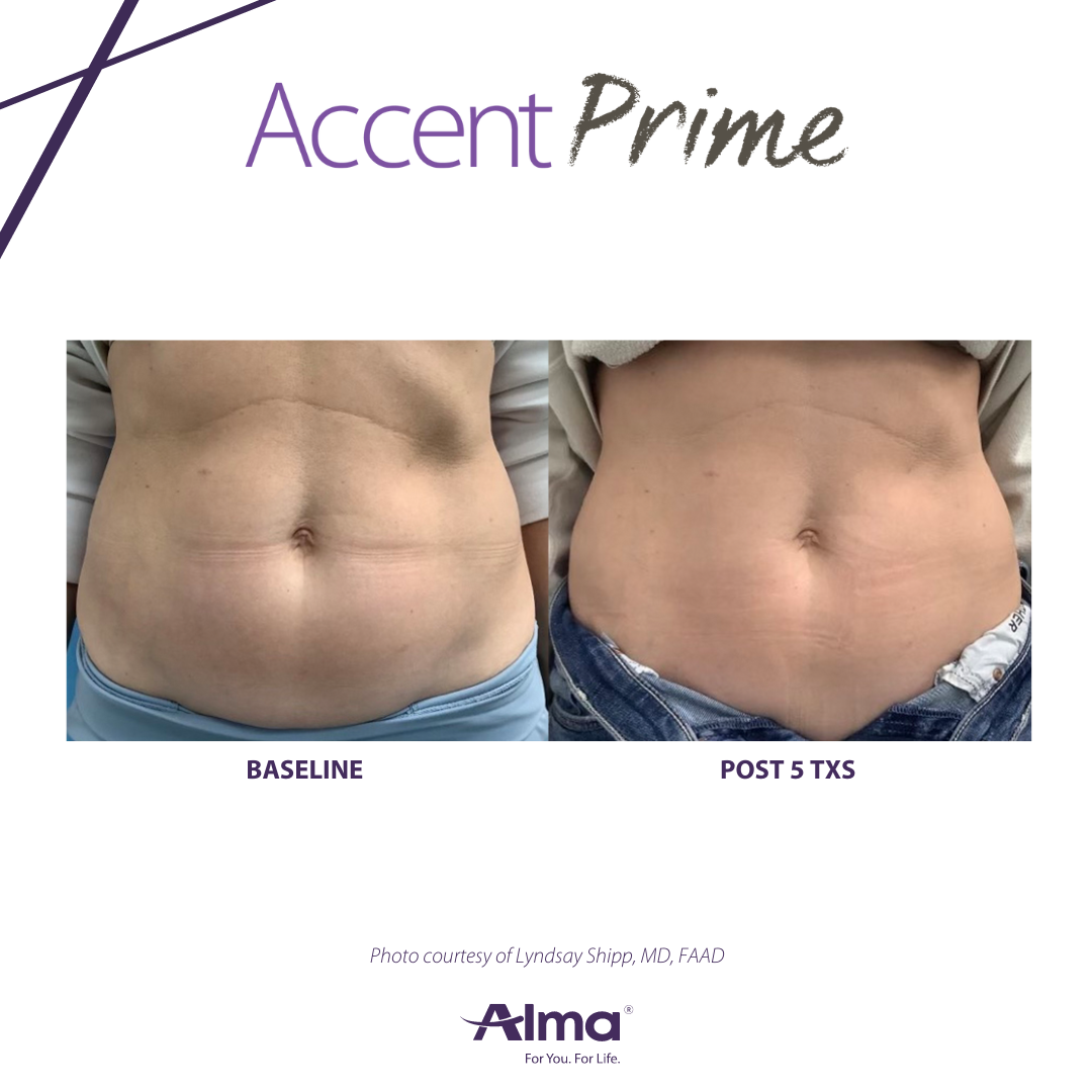 Accent Prime before and after body sculpting treatment results