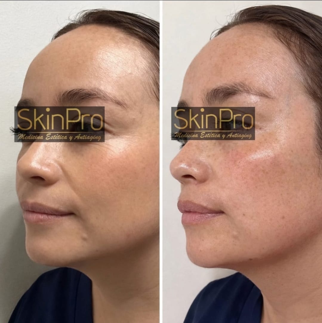 Resultado del tratamiento