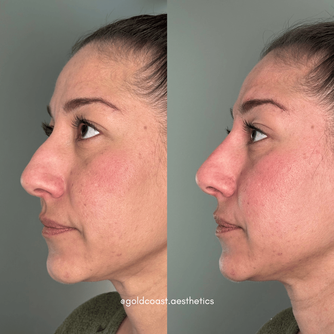 Nose filler transformation