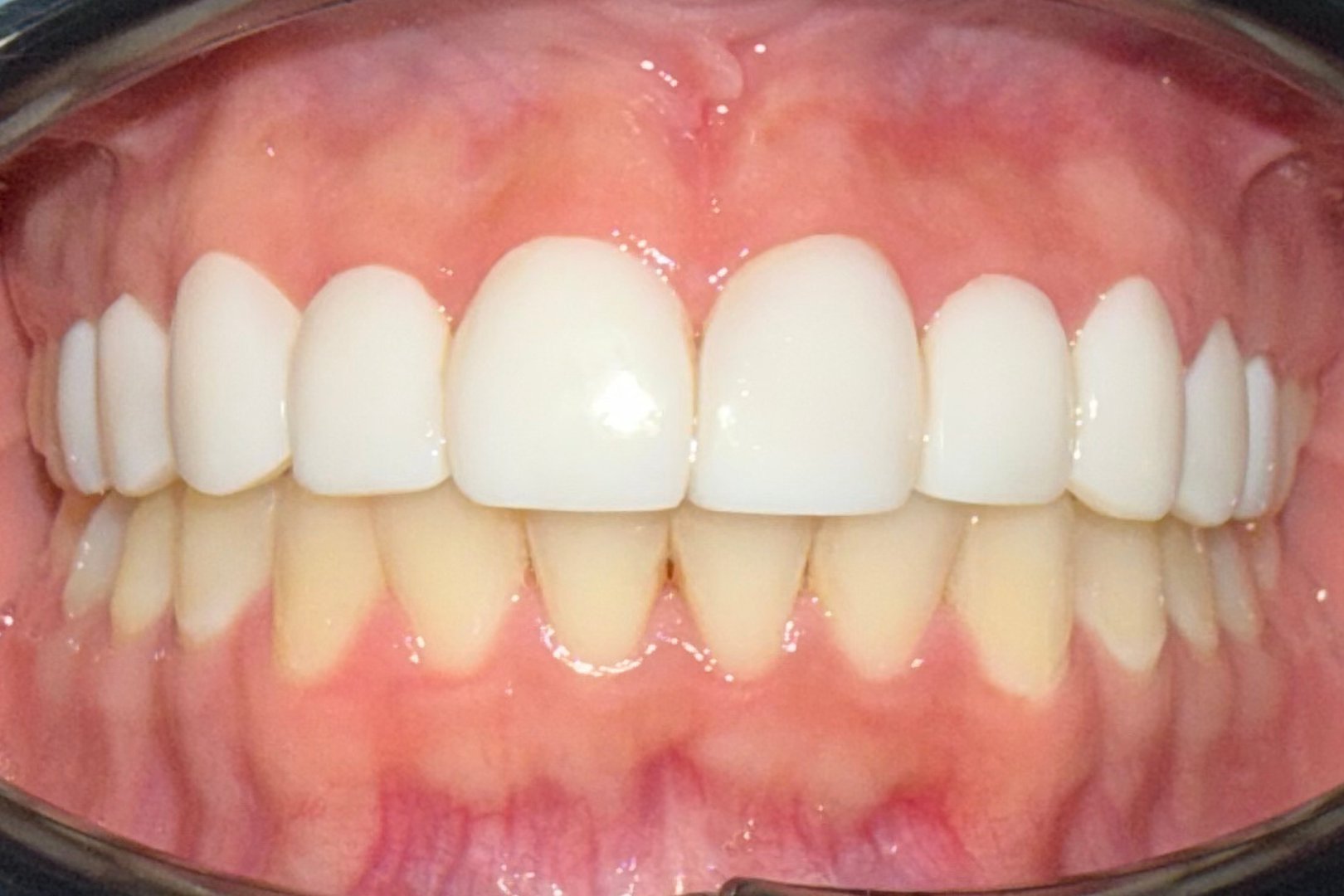 Restauración dental - Resultado