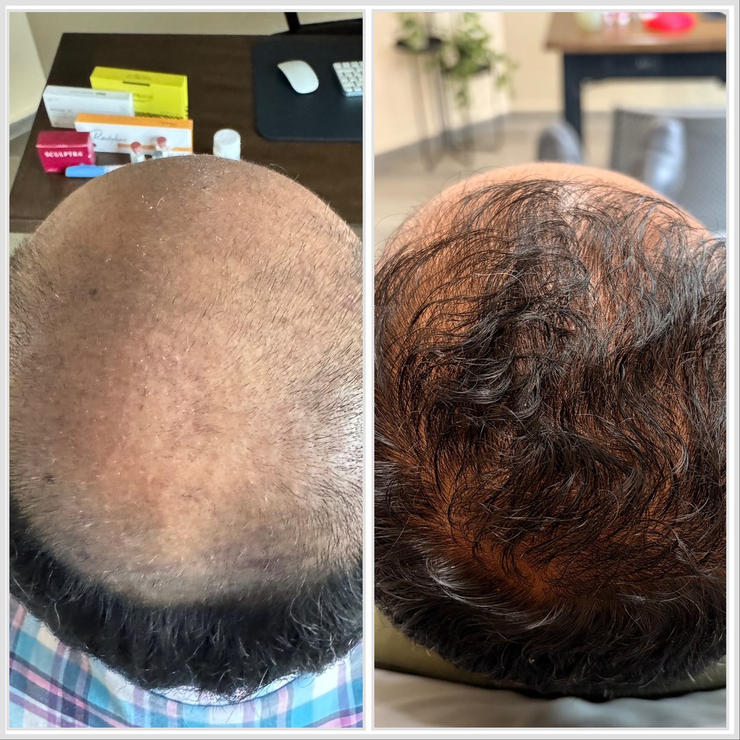 Antes y después de tratamiento de alopecia