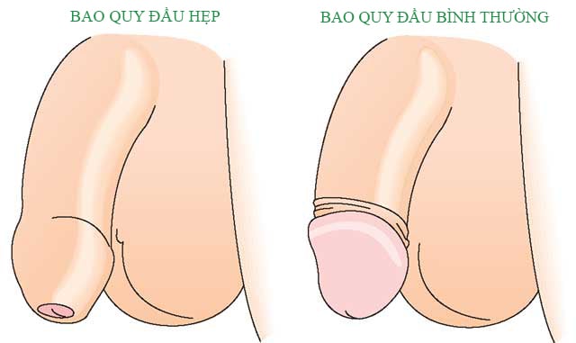 Hình ảnh minh họa hẹp bao quy đầu ở người lớn