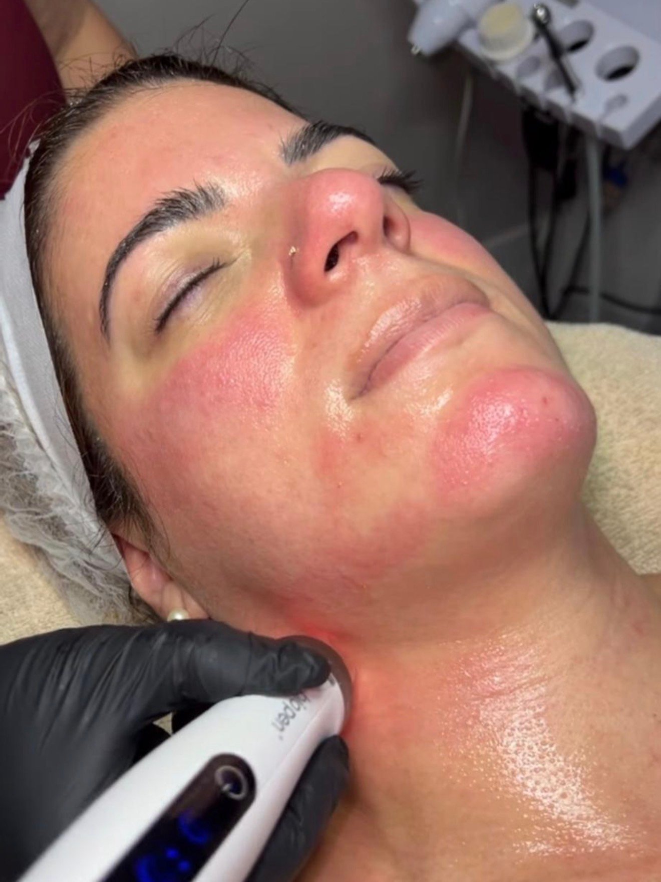 Resultado tratamiento Exosomas