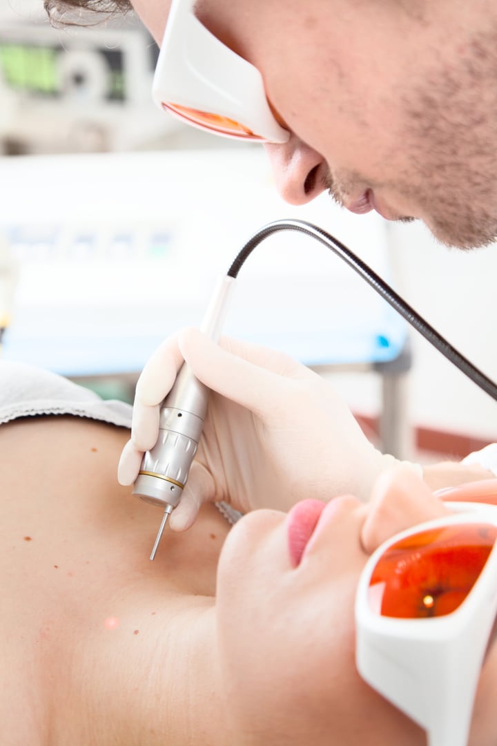 Clinician doing ablative CO2 fractional resurfacing of a female patients skin to remove wrinkles and blemishes by vaporising the uppermost layer, close up of her face in goggles and the equipment