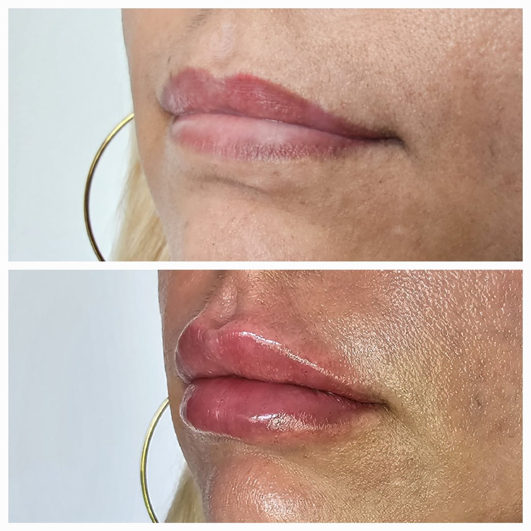 Resultado del tratamiento