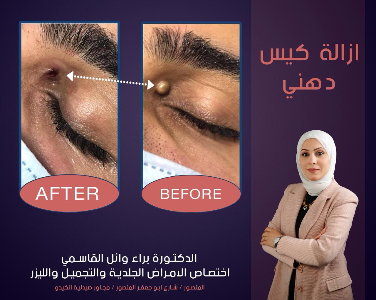 Before and after acne treatment results