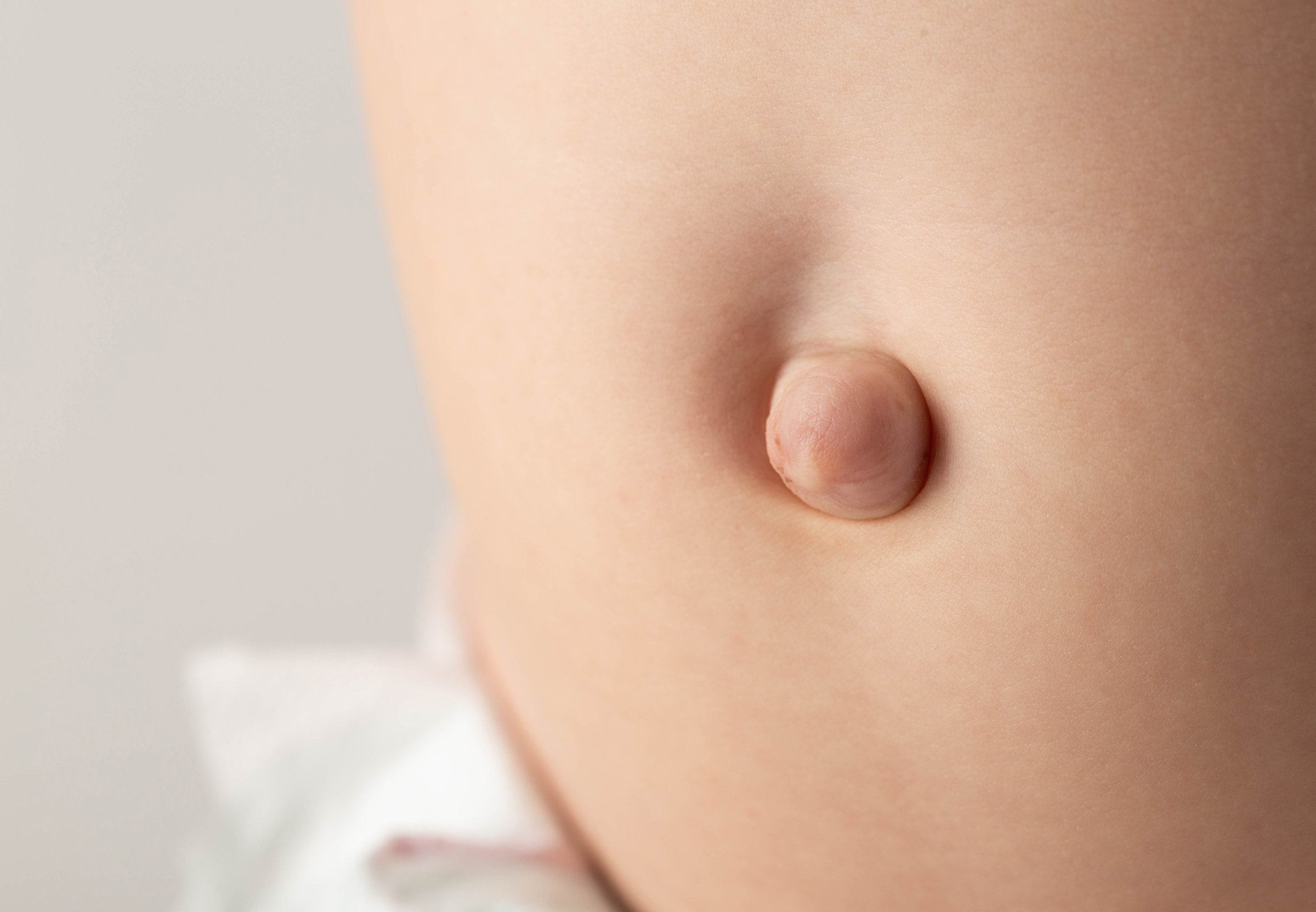 Umbilical hernia in a newborn baby on the stomach. Treatment of umbilical hernias in children without surgery, medical