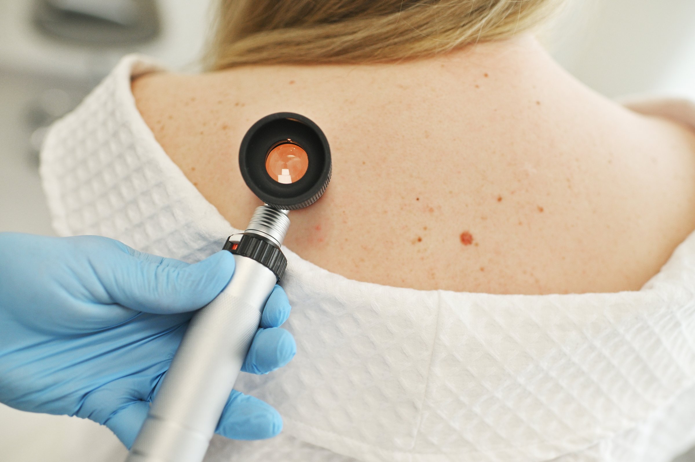 close-up - a dermatologist examines moles and skin growths on the patient's body using a special device - a dermatoscope. Diagnosis and prevention of melanoma.