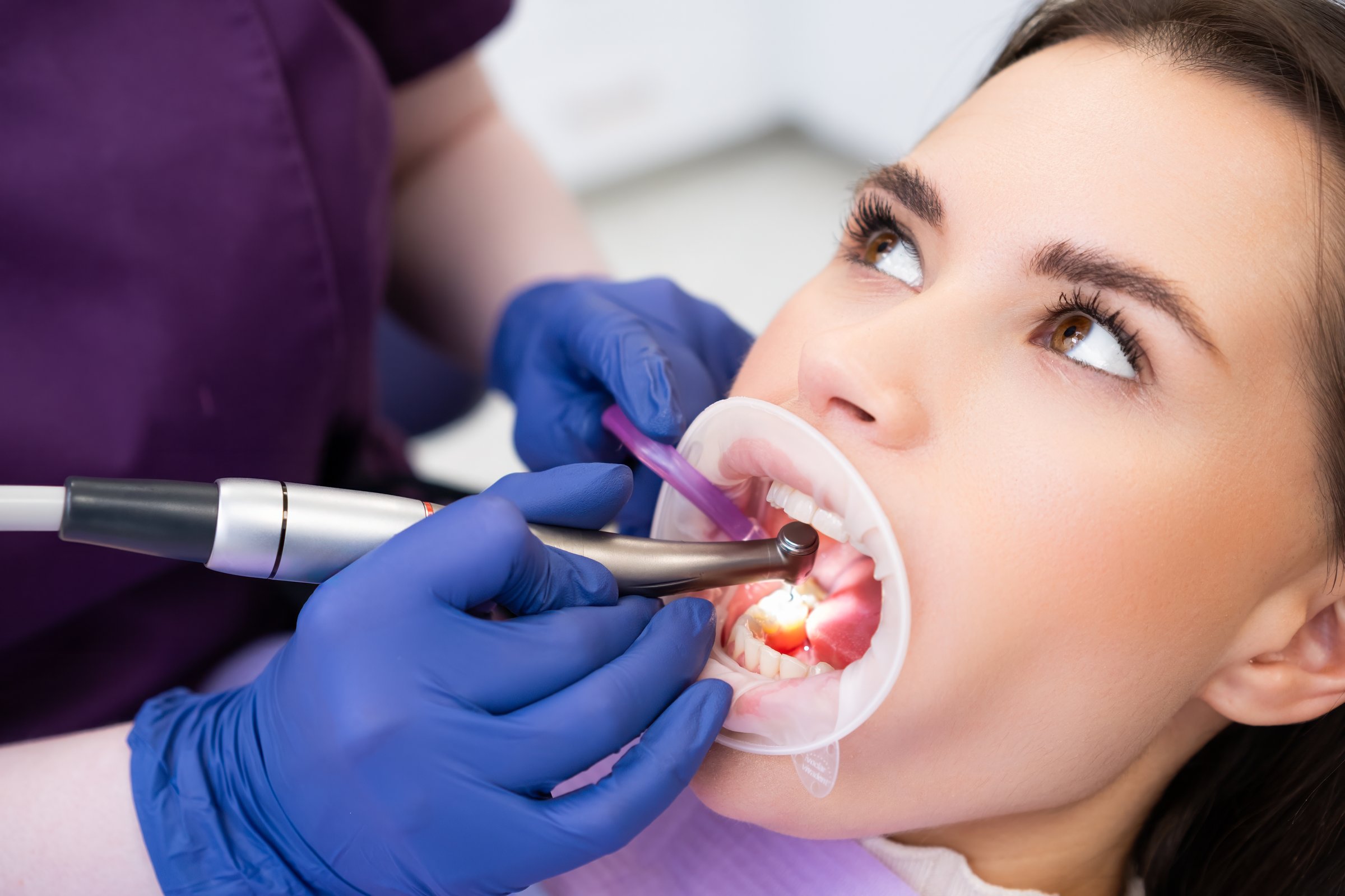 Dental professional carefully removes damaged area of tooth using drill tool. Young lady with optragate experiences tooth drilling procedure in clinic