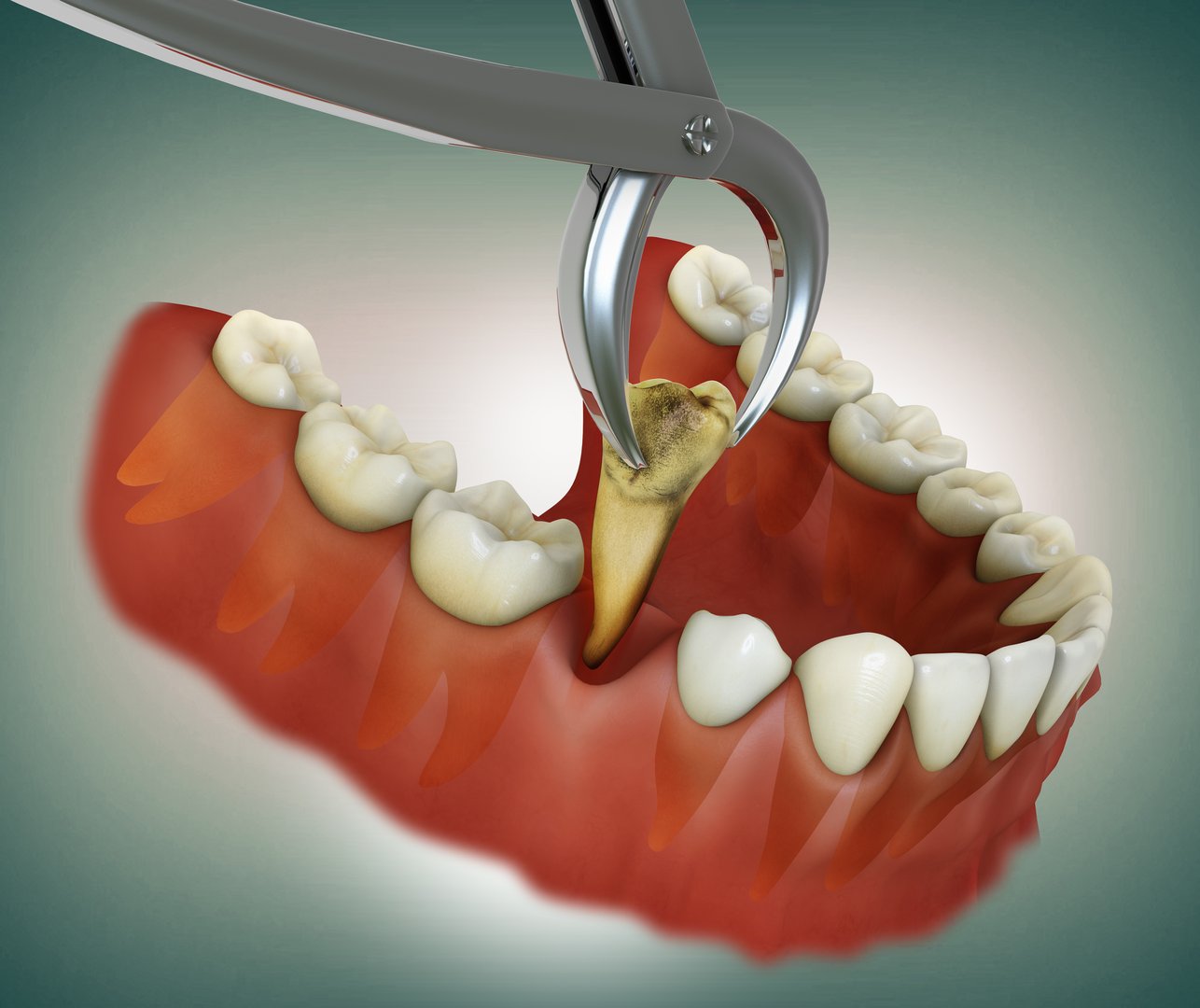 Dentist performing tooth extraction