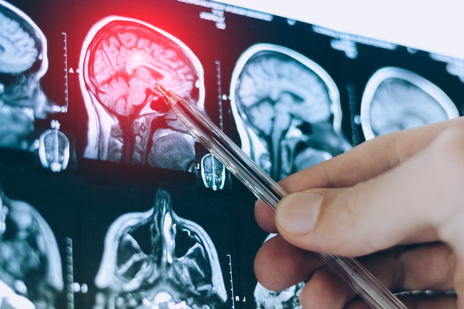 CT scan image of human brain. Mri or x-ray scan for diagnostic human head diseases.