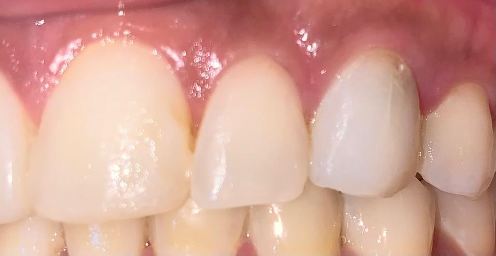 Después de tratamiento - corrección de diente manchado