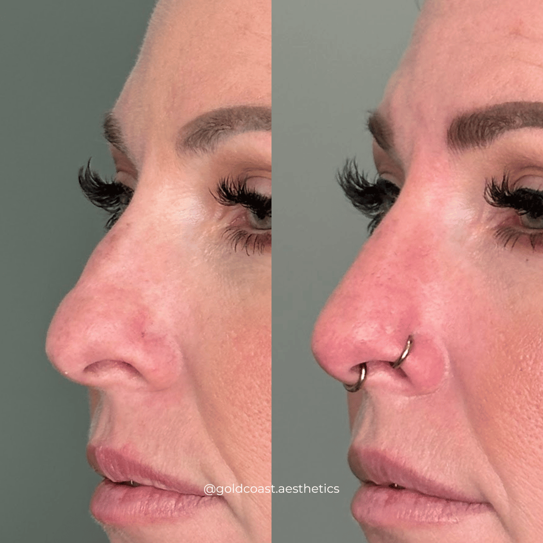 Nose filler before and after