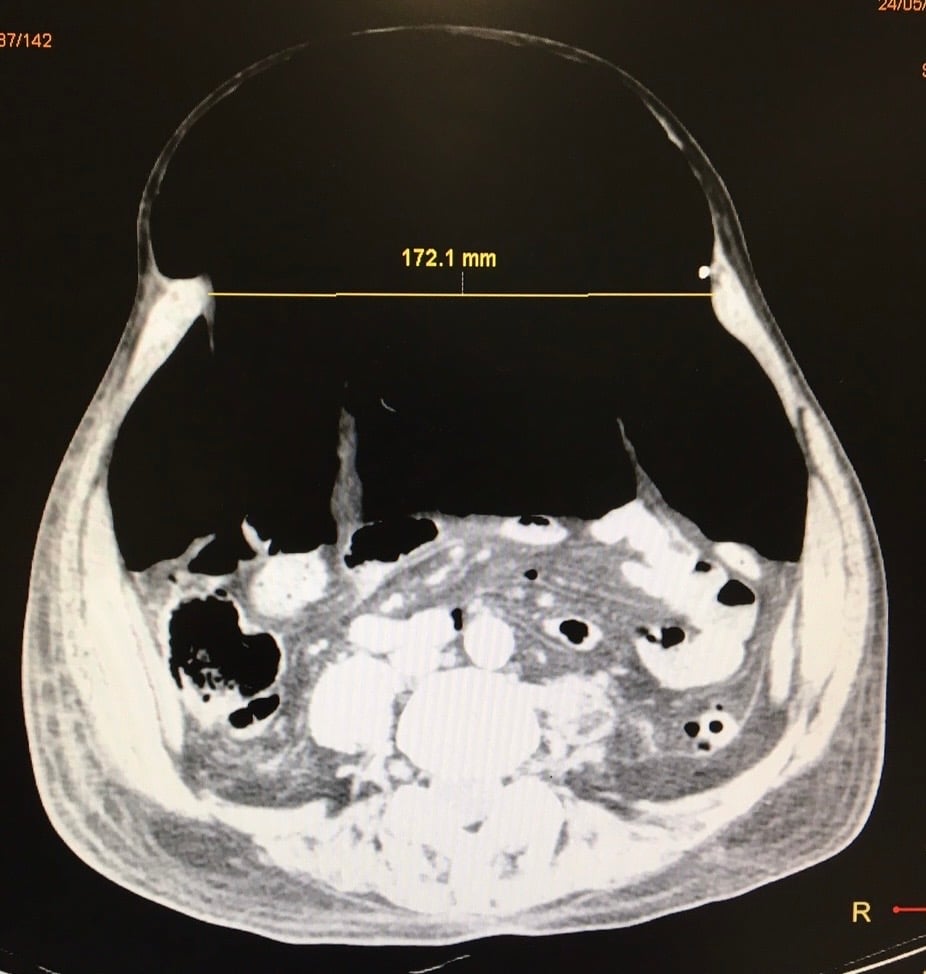 Insuflación Progresiva - Técnica Preoperatoria