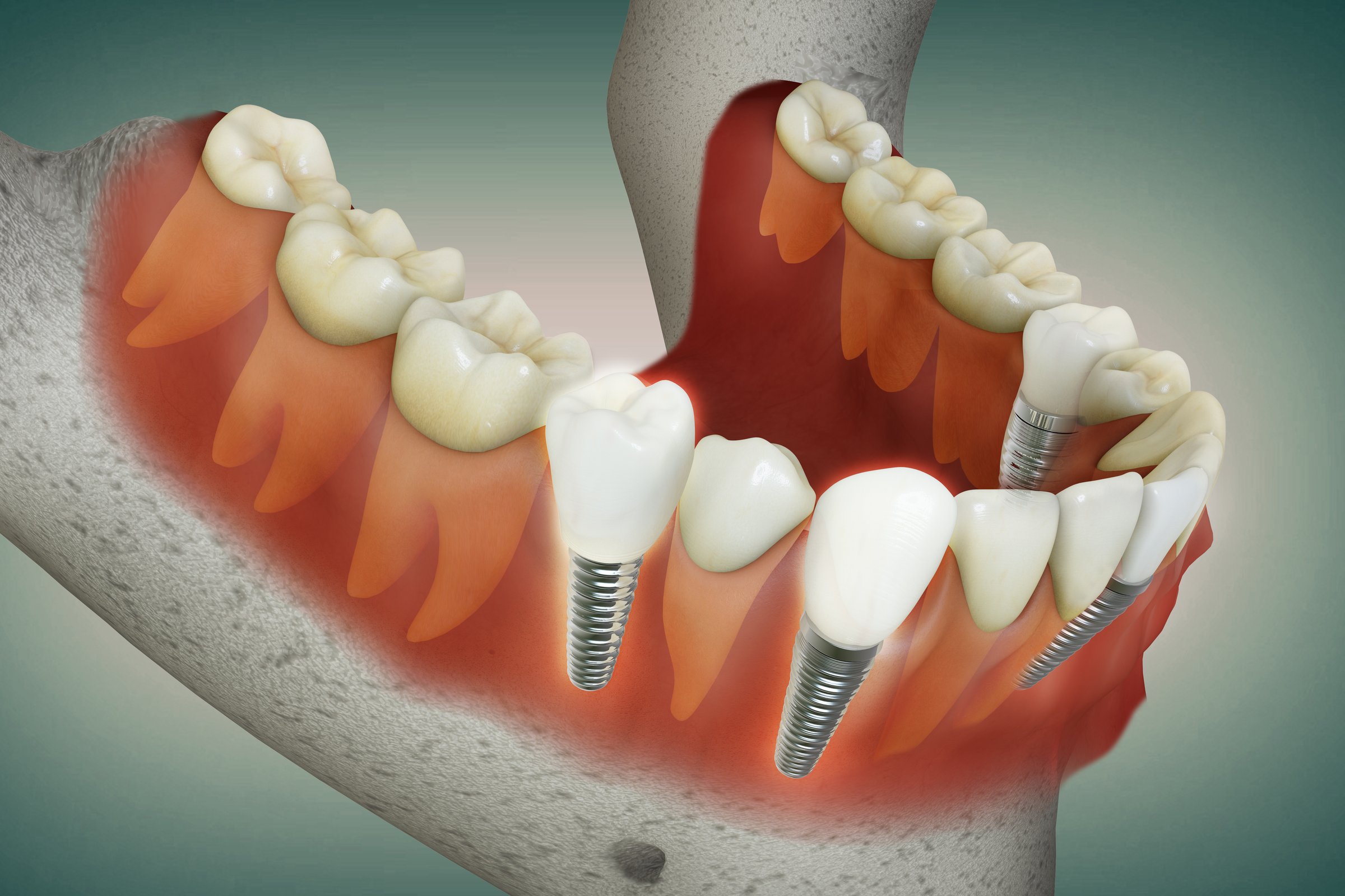 3D rendering image of multiple teeth implant…aligning beautifully with healthy teeth-gums and jaw bones