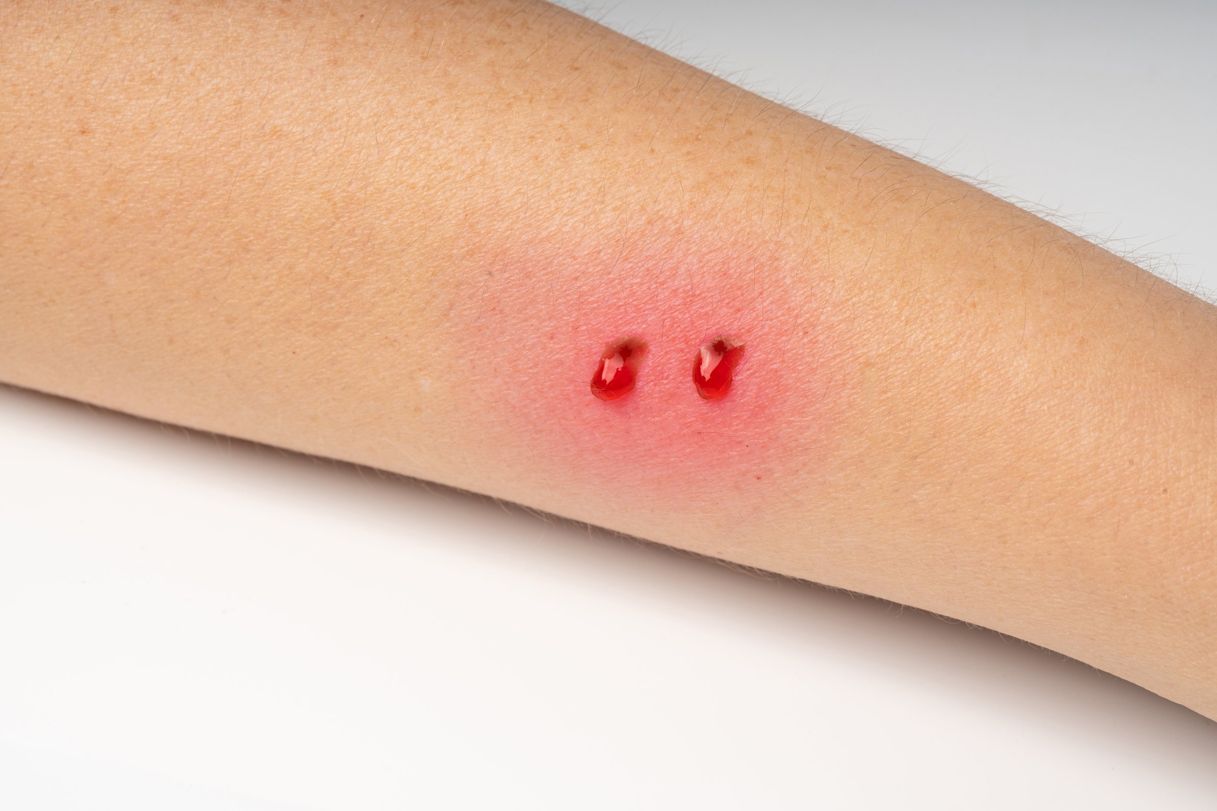 Snake bite on skin, snakebite or cat bite marks close up. Two small fresh blood drops on hand skin with copy space