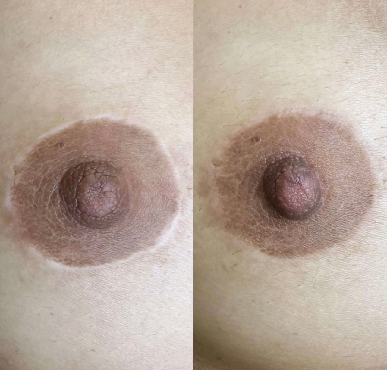 Before and after breast restoration scar camouflage result