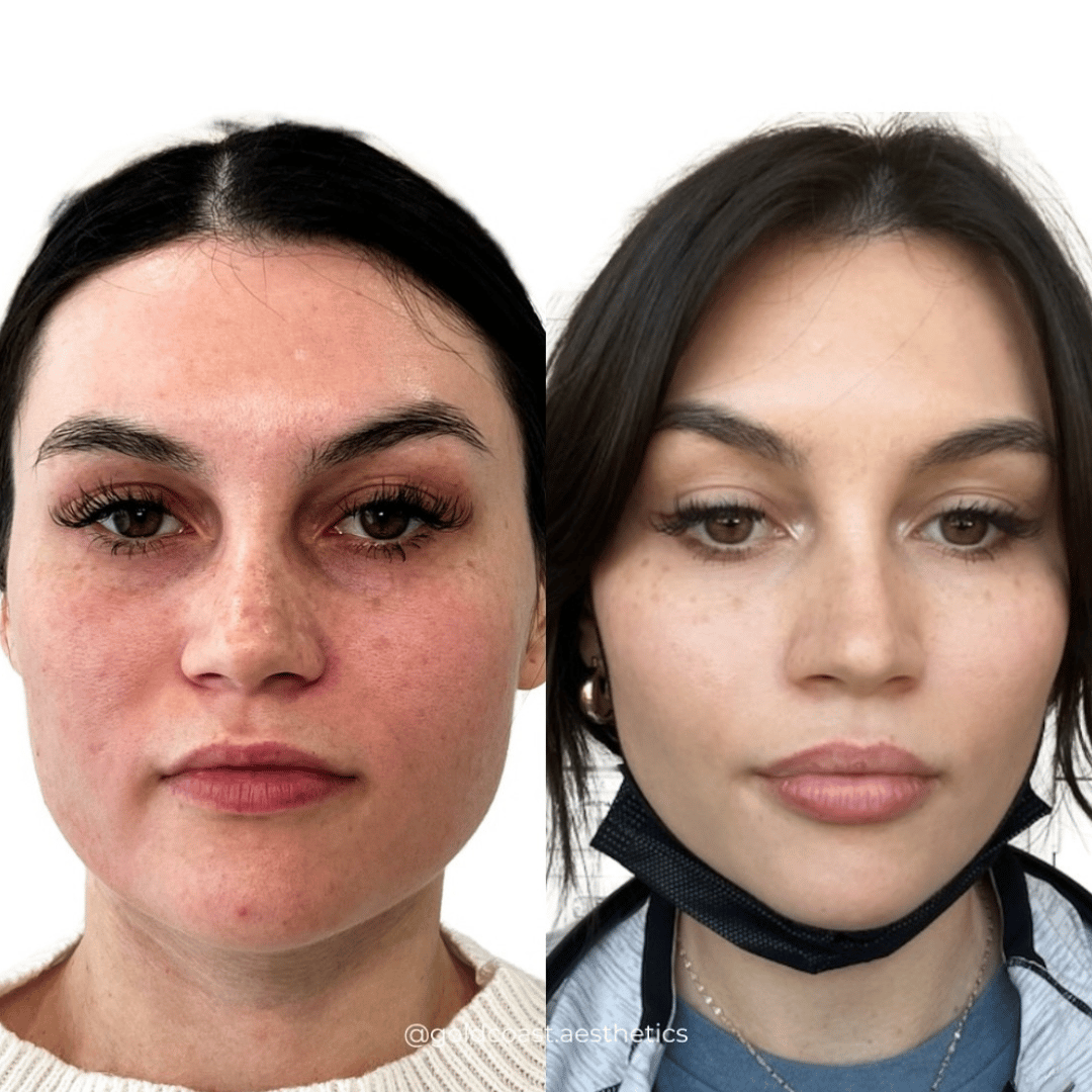 Complete face transformation