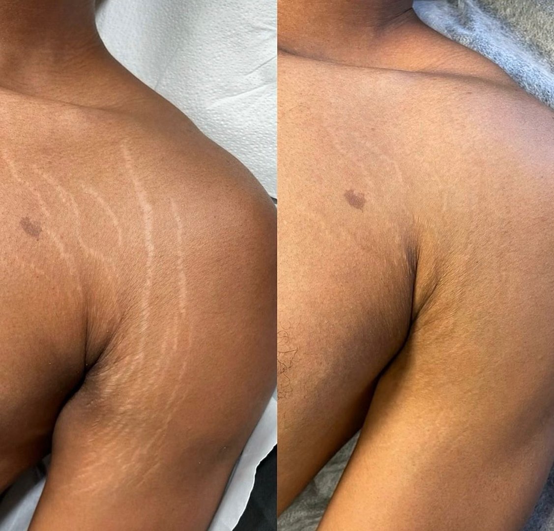 Weight loss stretch marks before and after 1 session