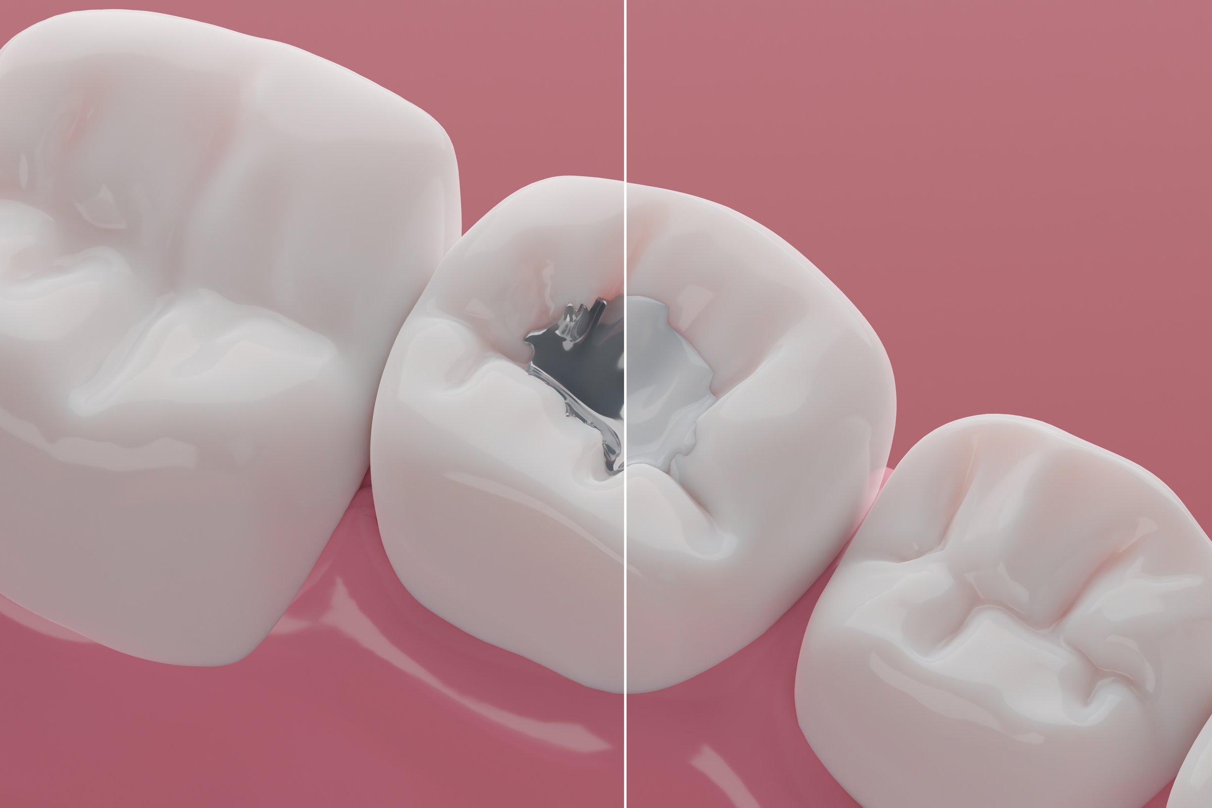 Teeth Mercury or Silver Amalgam Fillings Compare to Composites, Declay treatment and Dental clinic illustration concept.