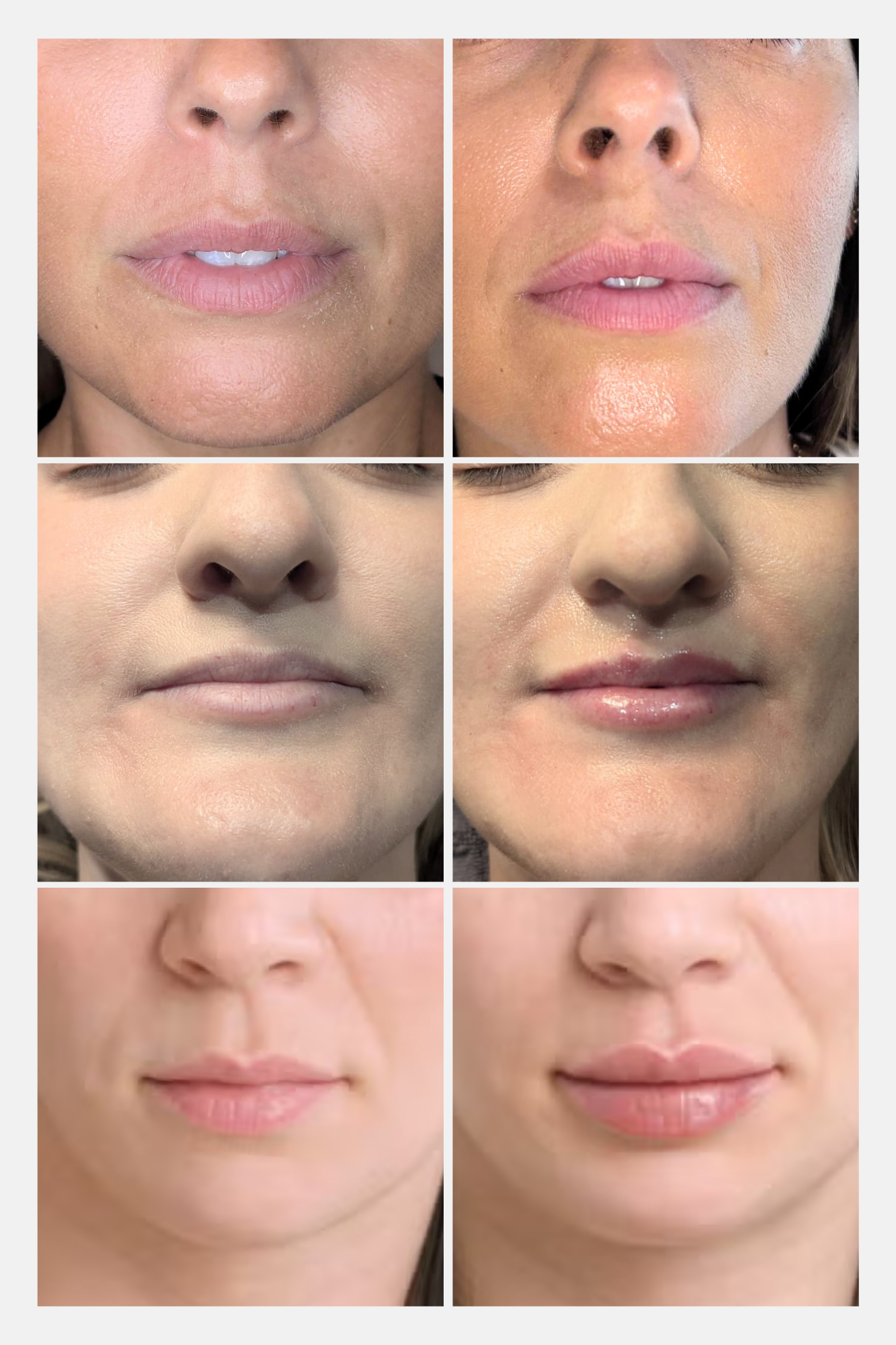 Before and after lip treatment